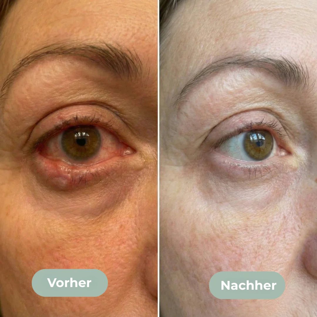 Eye Relief Pro